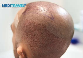 Czy przeszczep włosów boli? Realistyczne spojrzenie na cały proces