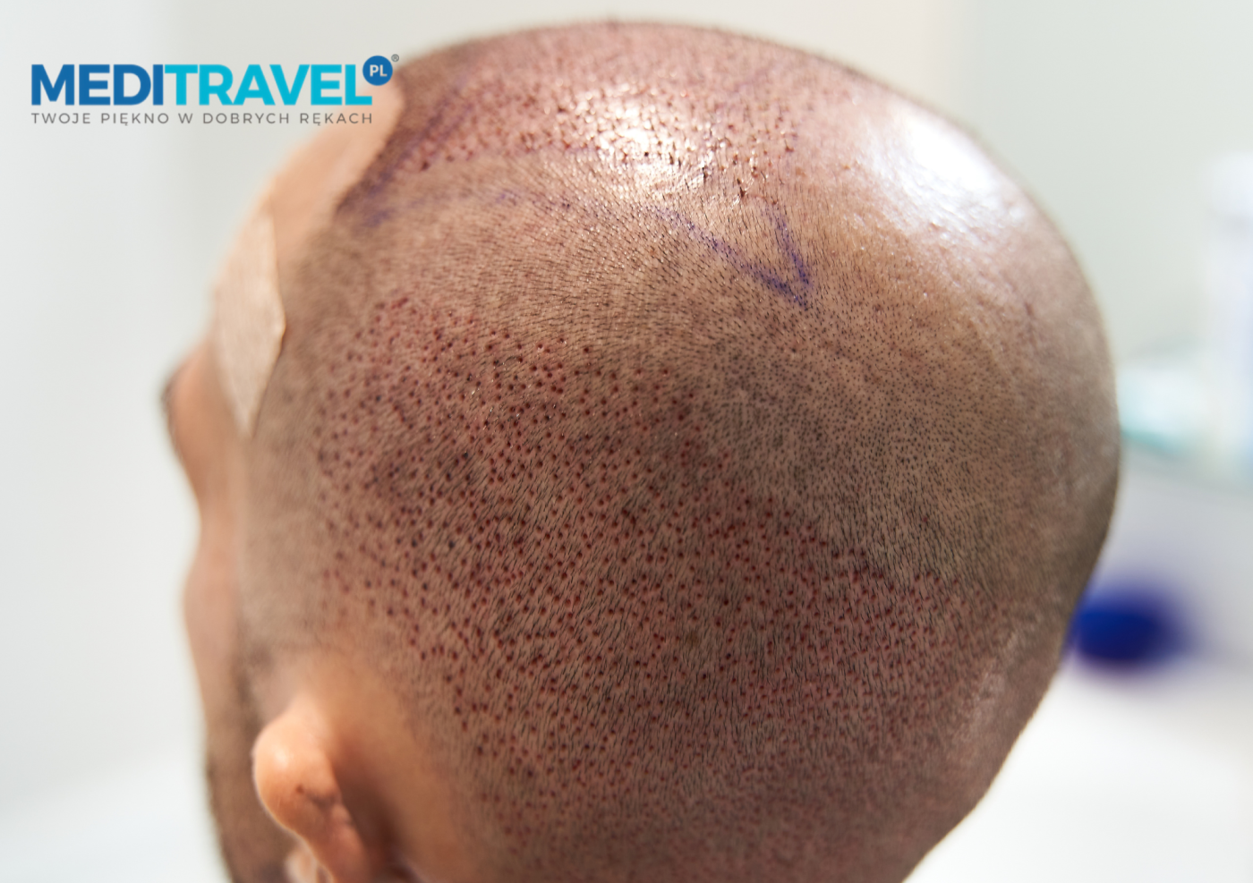 Czy przeszczep włosów boli? Realistyczne spojrzenie na cały proces