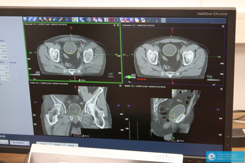 6/6 Radioterapia z pierwszymi pacjentami